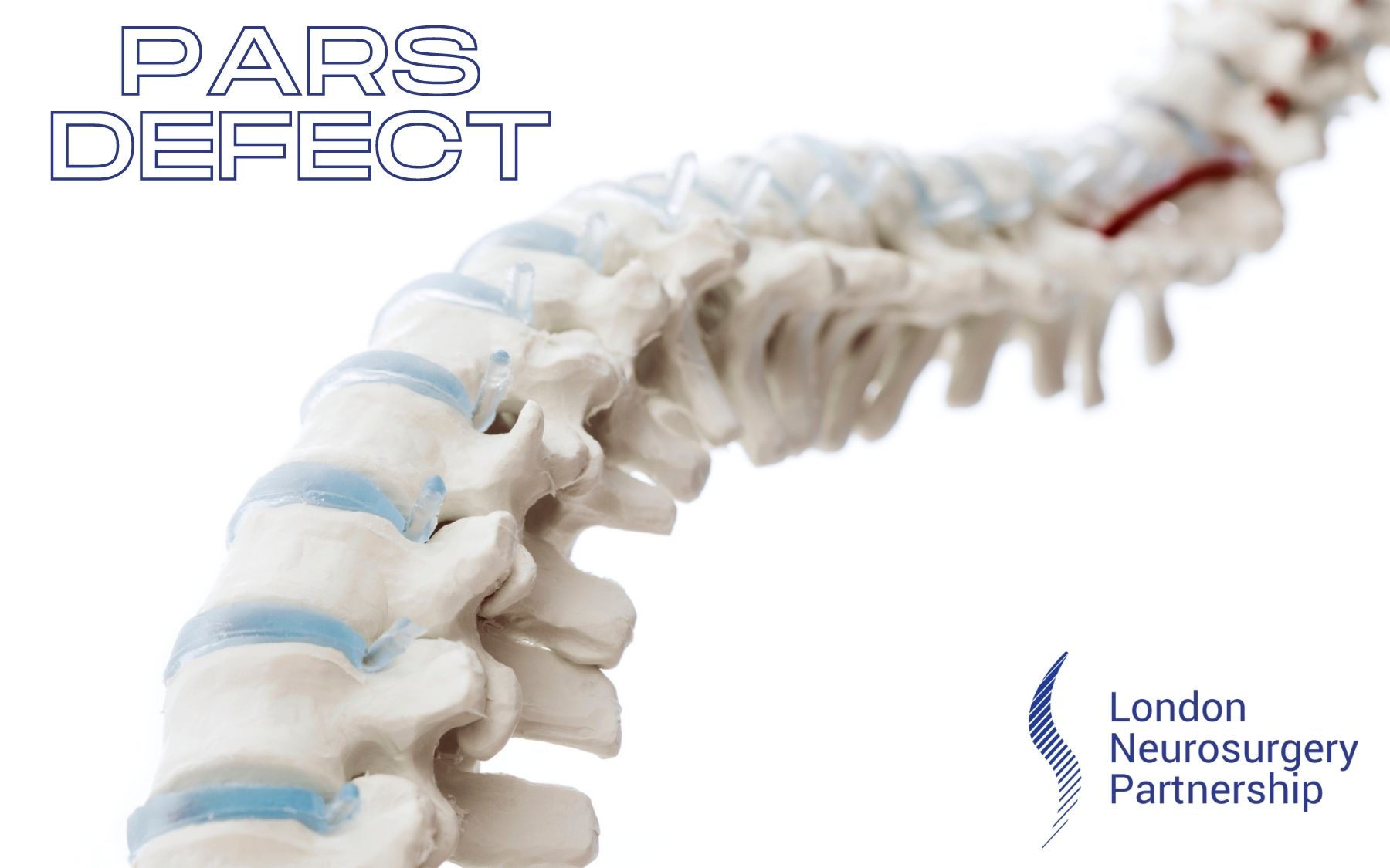 Pars Defect London Neurosurgery Spine Neurosurgery