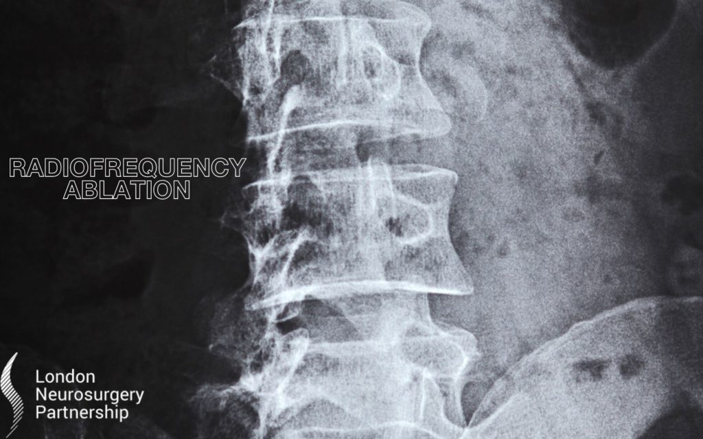 Radiofrequency ablation