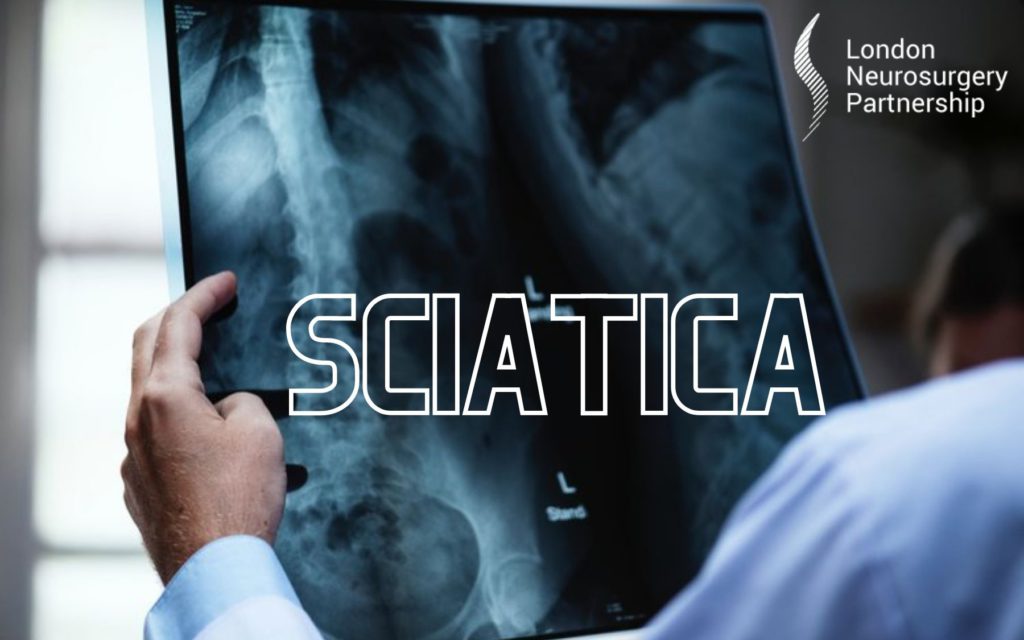 sciatica london neurosurgery partnership