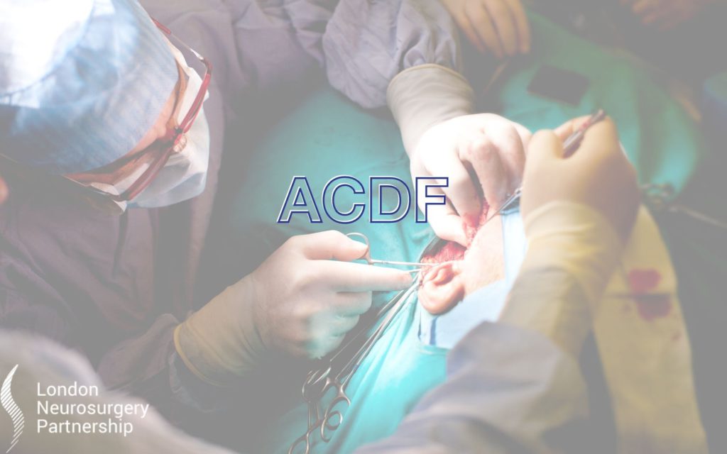 ACDF london neurosurgery partnership