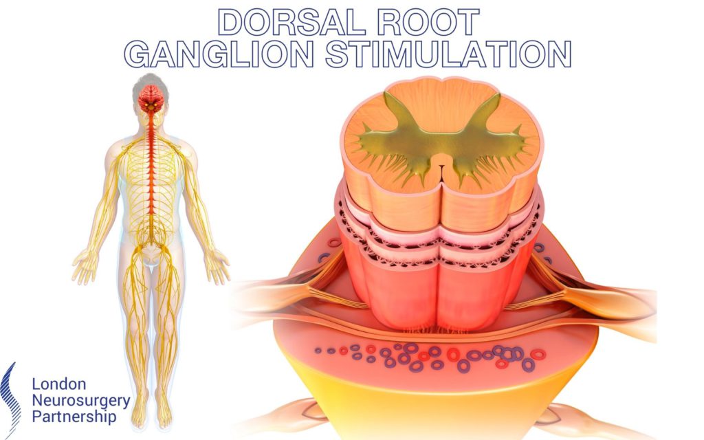 dorsal root ganglion stimulation