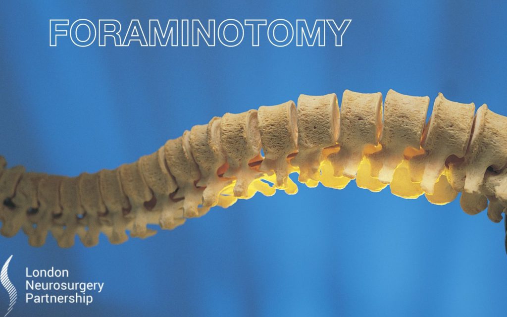 foraminotomy london neurosurgery partnership