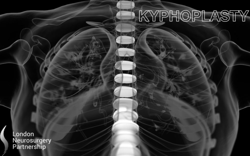 kyphoplasty london neurosurgery partnership