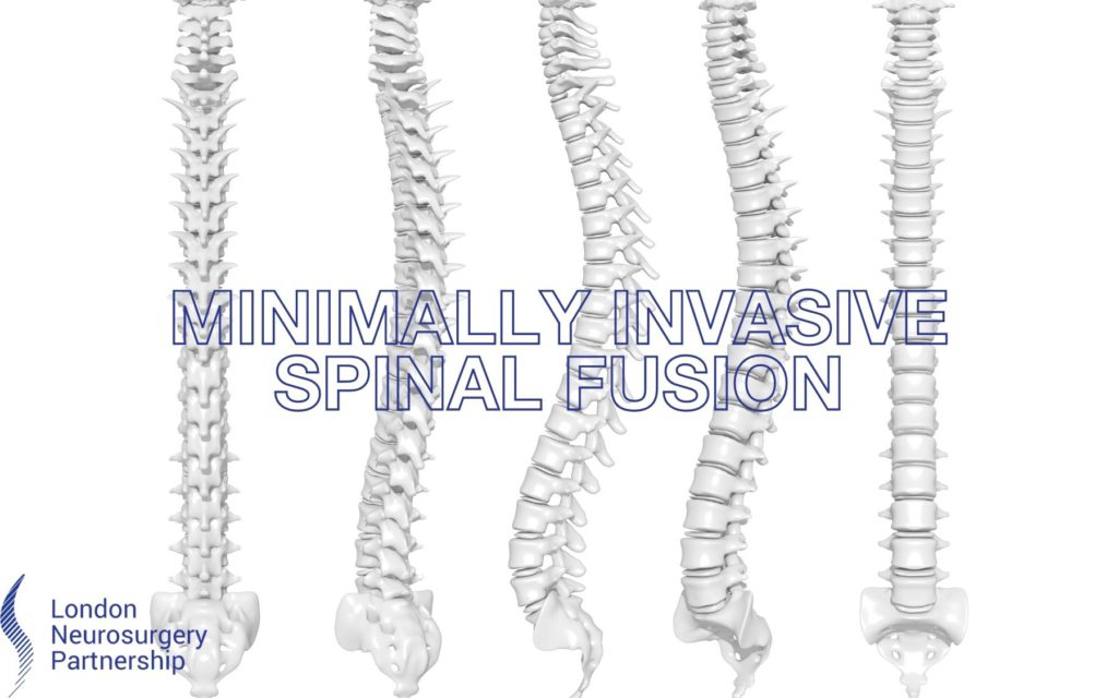 minimally-invasive-spinal-fusion