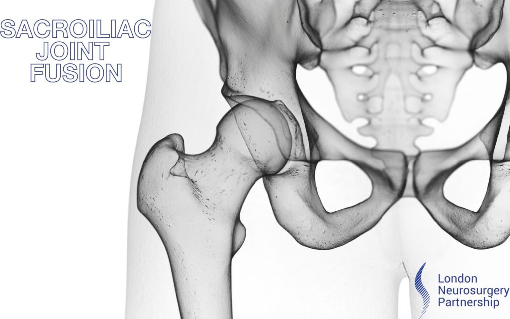 sacroiliac joint fusion