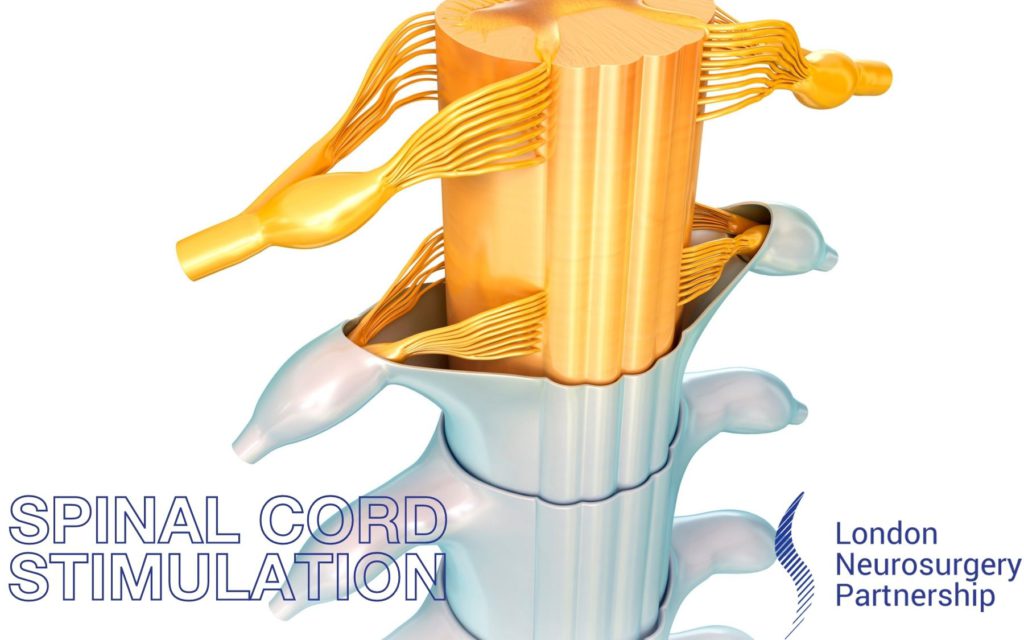 spinal cord stimulation