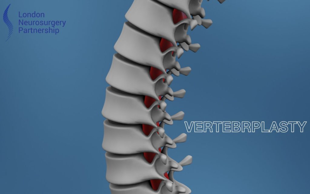 vertebroplasty london neurosurgery