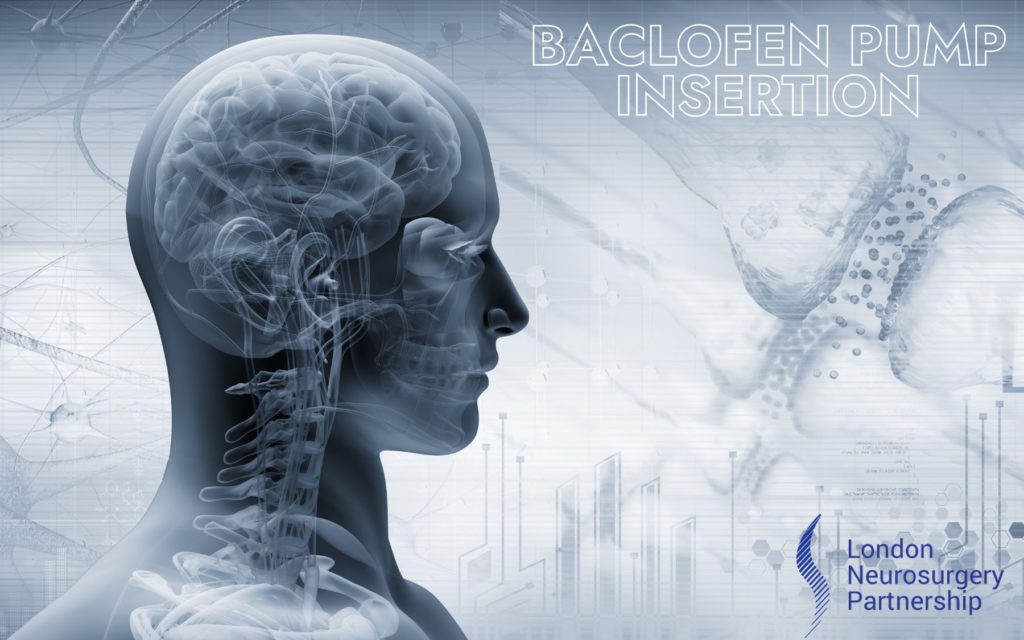 Baclofen pump - London Neurosurgery - Spine & Neurosurgery