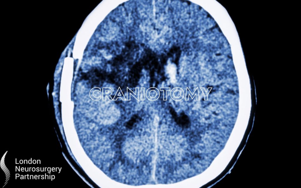 craniotomy