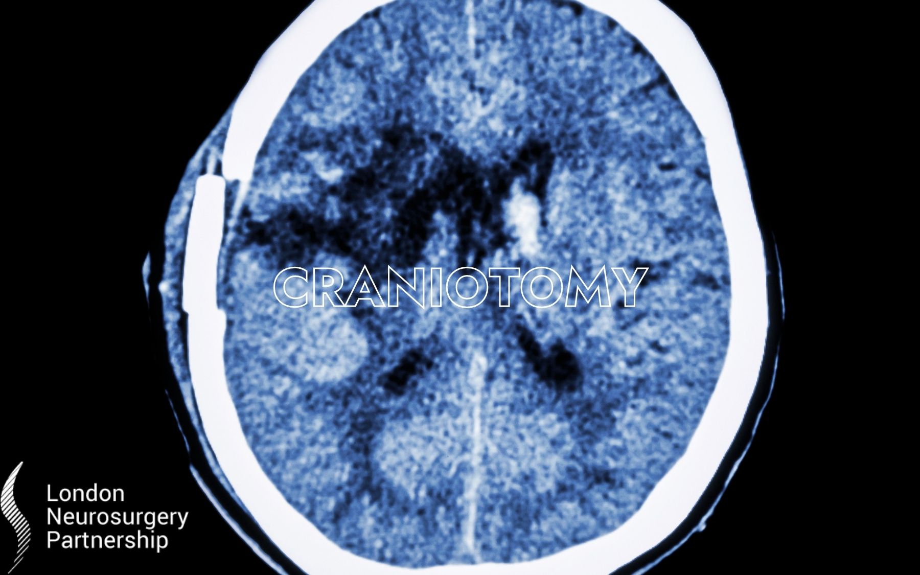 craniotomy-london-neurosurgery-spine-neurosurgery