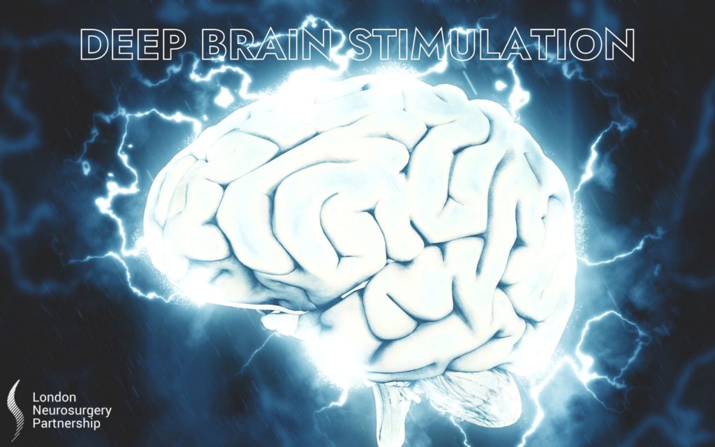 deep brain stimulation