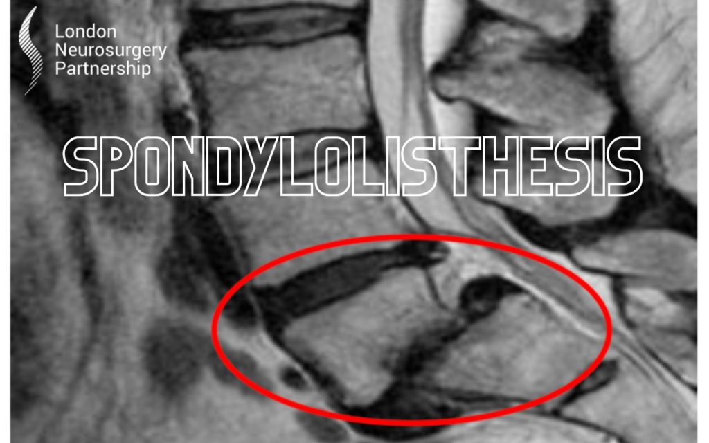 spondylolisthesis london neurosurgery partnership