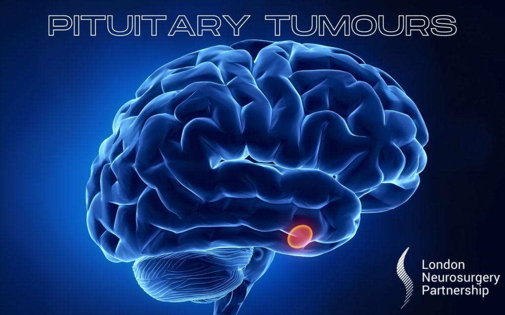 pituitary tumour london neurosurgery partnership