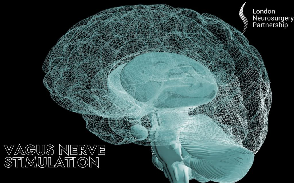 vagus nerve stimulation