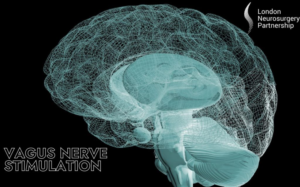 vagus-nerve-stimulation-london-neurosurgery-partnership