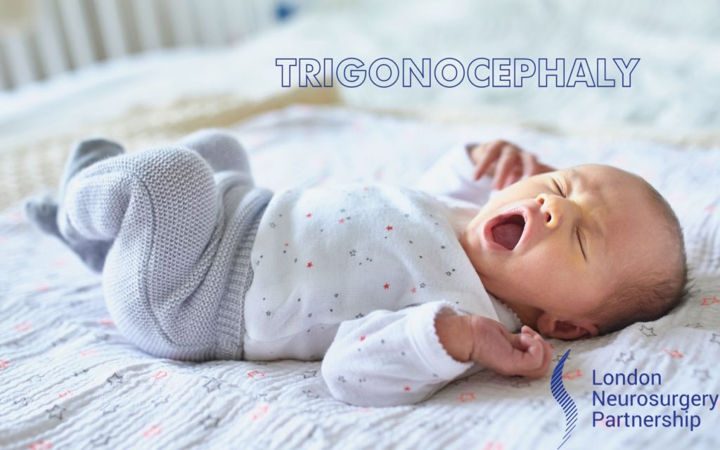 trigonocephaly