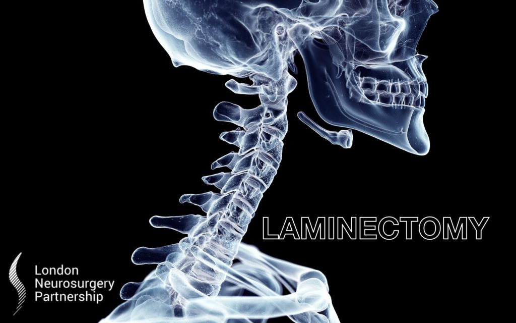 laminectomy london neurosurgery partnership