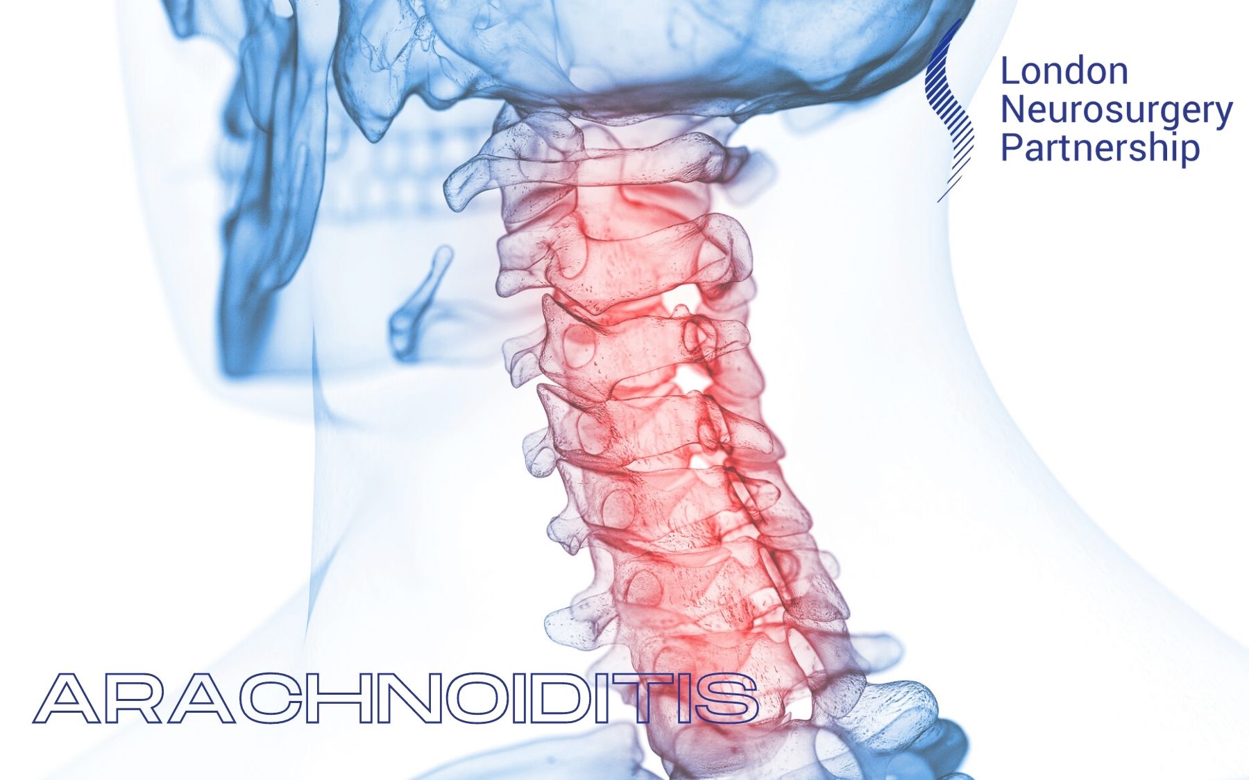 Arachnoiditis - London Neurosurgery - Spine & Neurosurgery