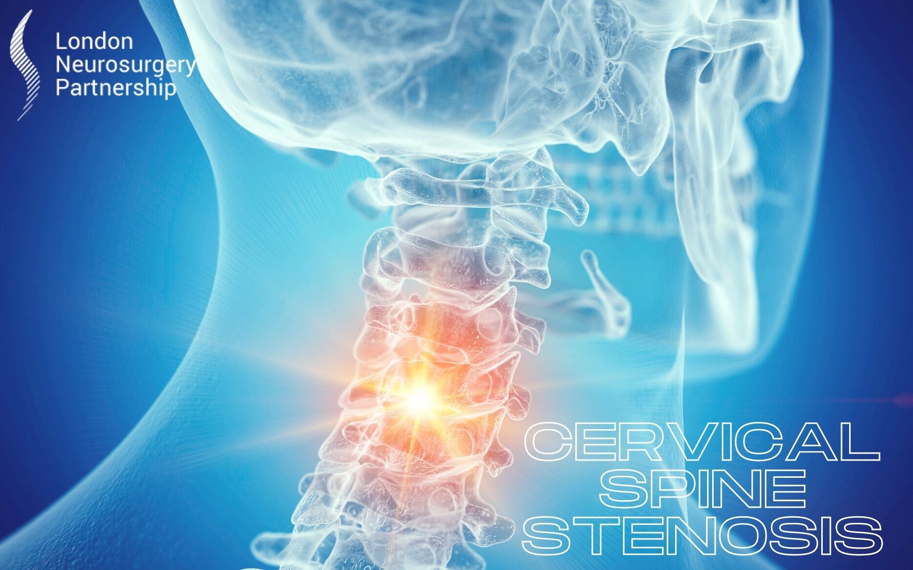 Cervical spine stenosis - London Neurosurgery - Spine