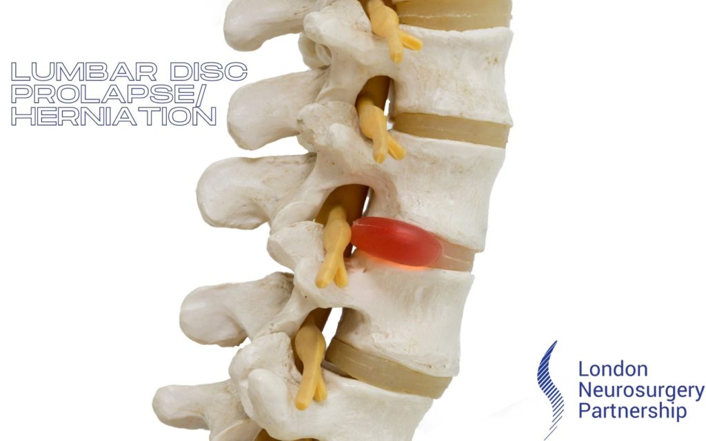 Lumbar disc herniation london neurosurgery partnership