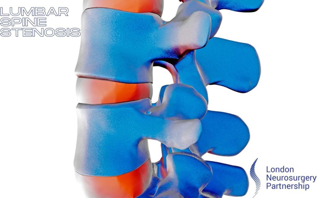 lumbar spine stenosis london neurosurgery partnership