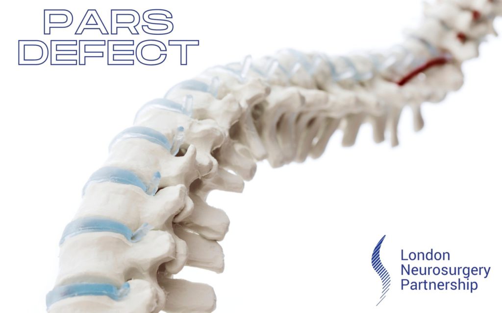 pars defect london neurosurgery partnership