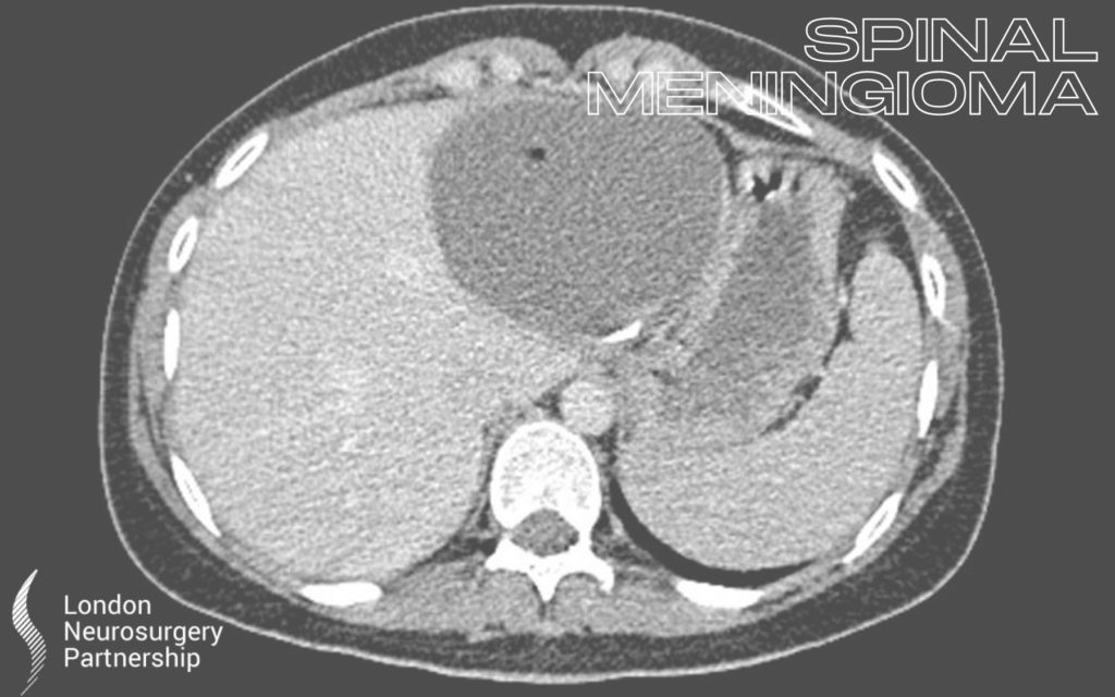 spinal meningioma london neurosurgery partneraship