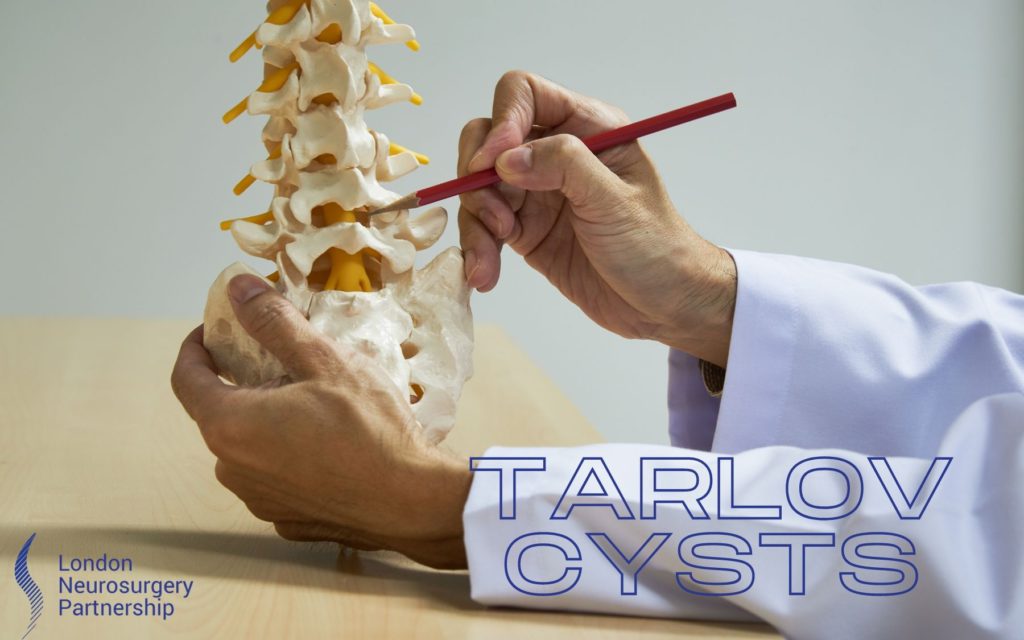 Tarlov cysts london neurosurgery partnership