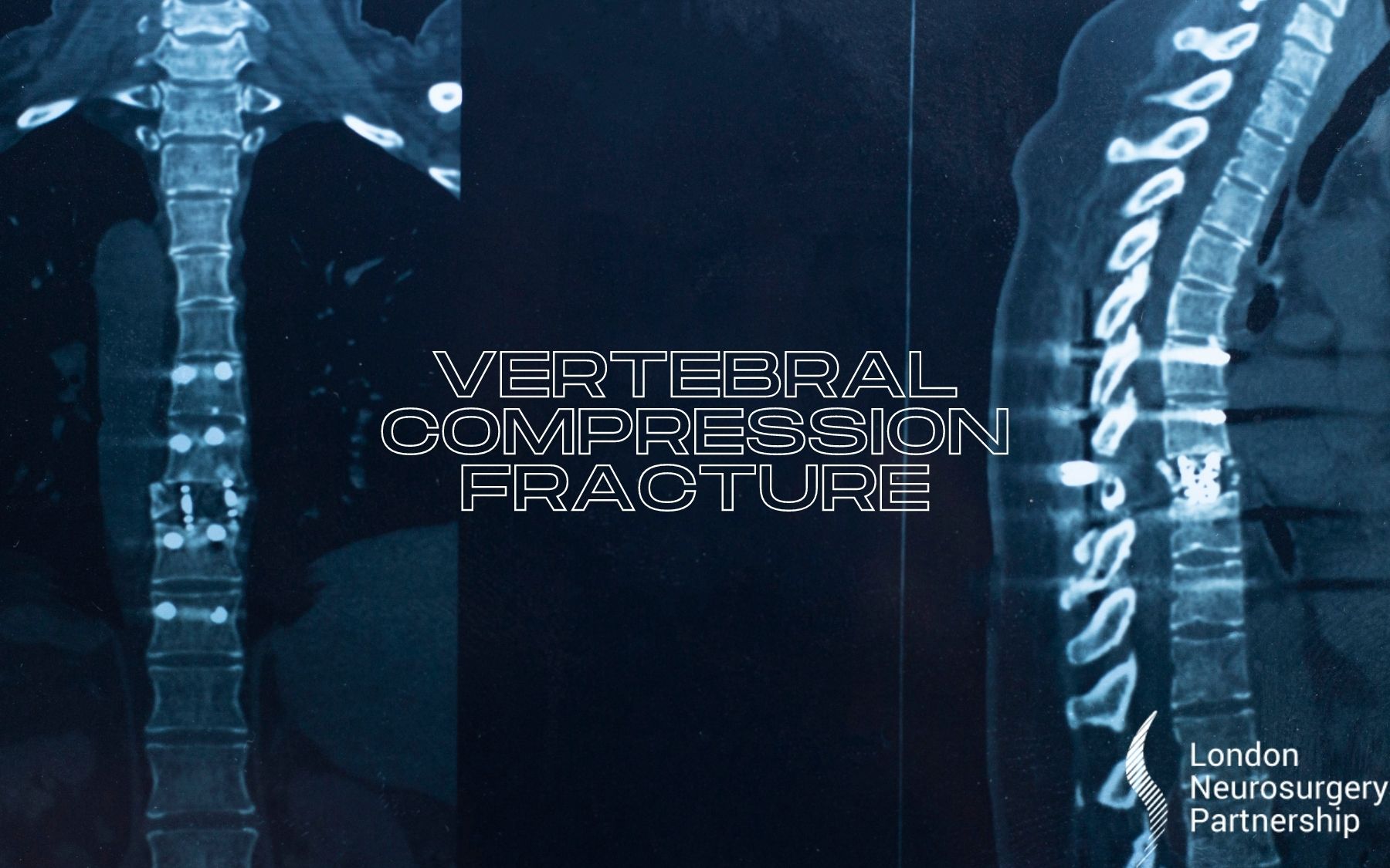 Vertebral Compression Fractures – Symptoms, Complications