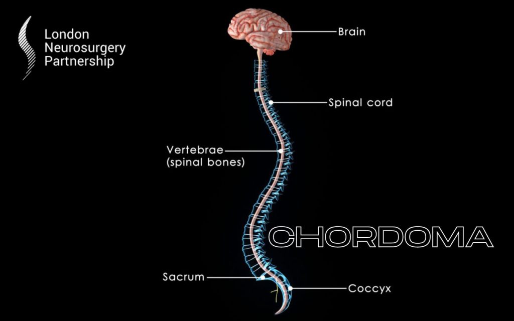 chordoma london neurosurgery partnership