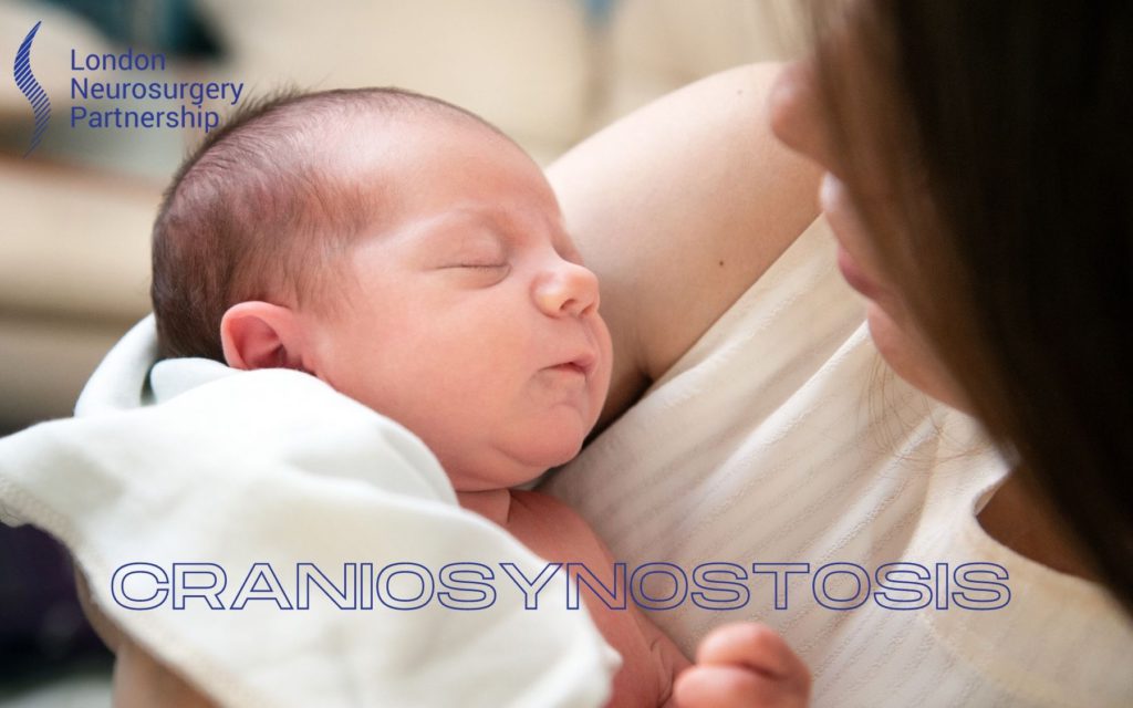 craniosynostosis london neurosurgery partnership