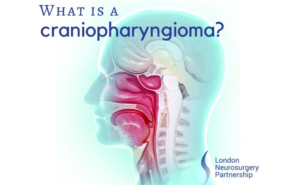 craniopharyngioma london neurosurgery partnership