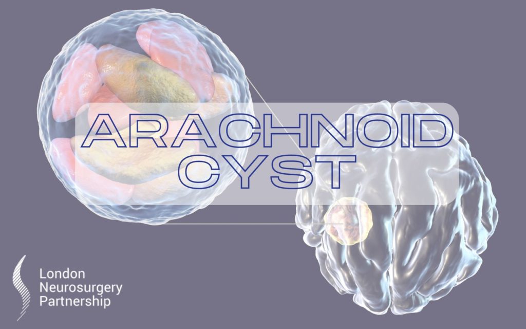 arachnoid cyst london neurosurgery partnership