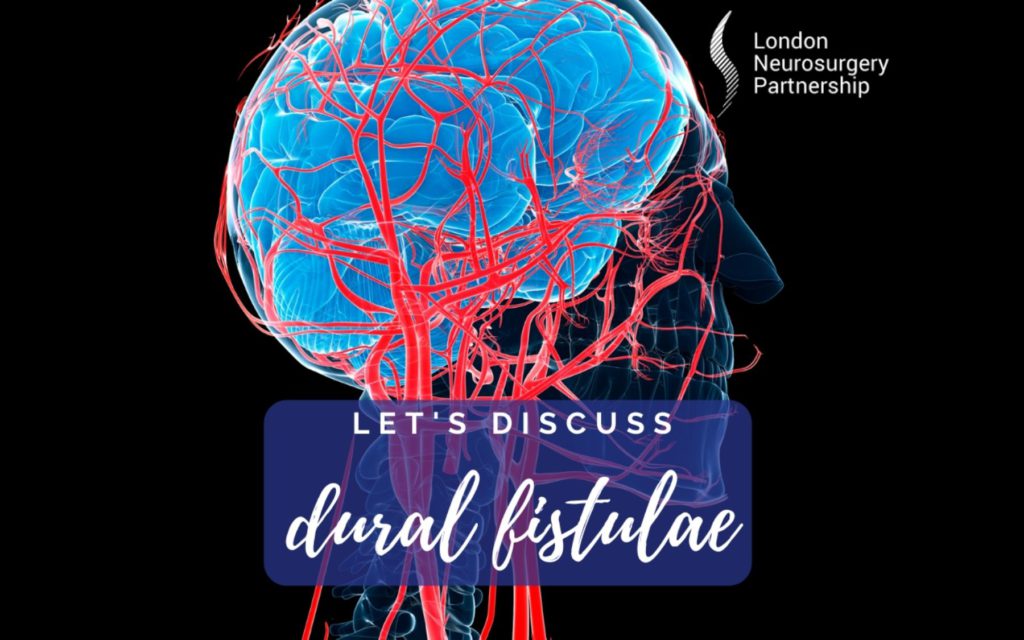 Dural fistula london neurosurgery partnership