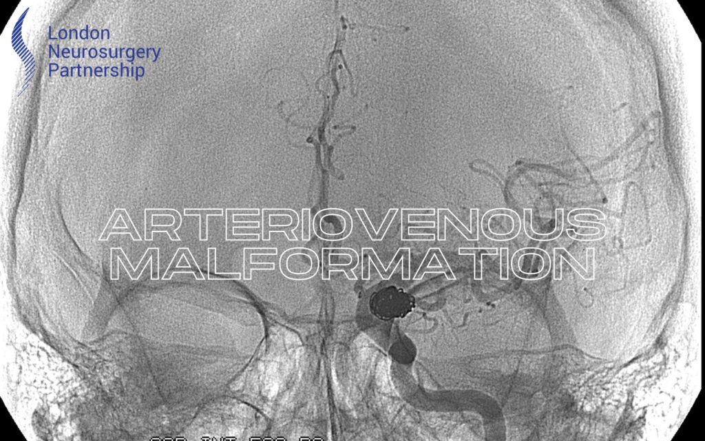 arteriovenous malformation london neurosurgery partnership