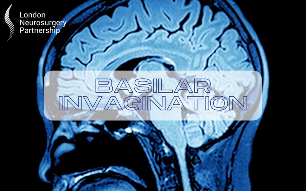 basilar invagination london neurosurgery partnership