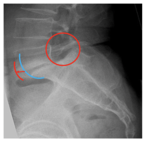 London Neurosurgery Partnership Pars defect. 