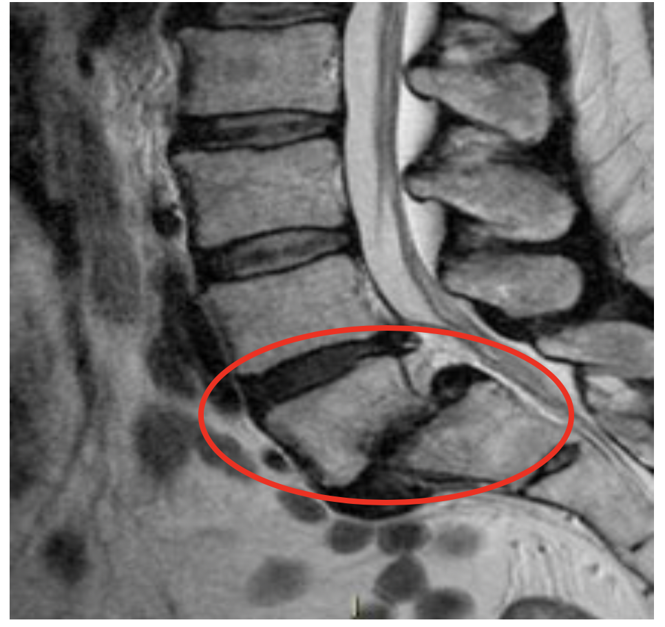 London Neurosurgery Partnership Pars defect diagnostic