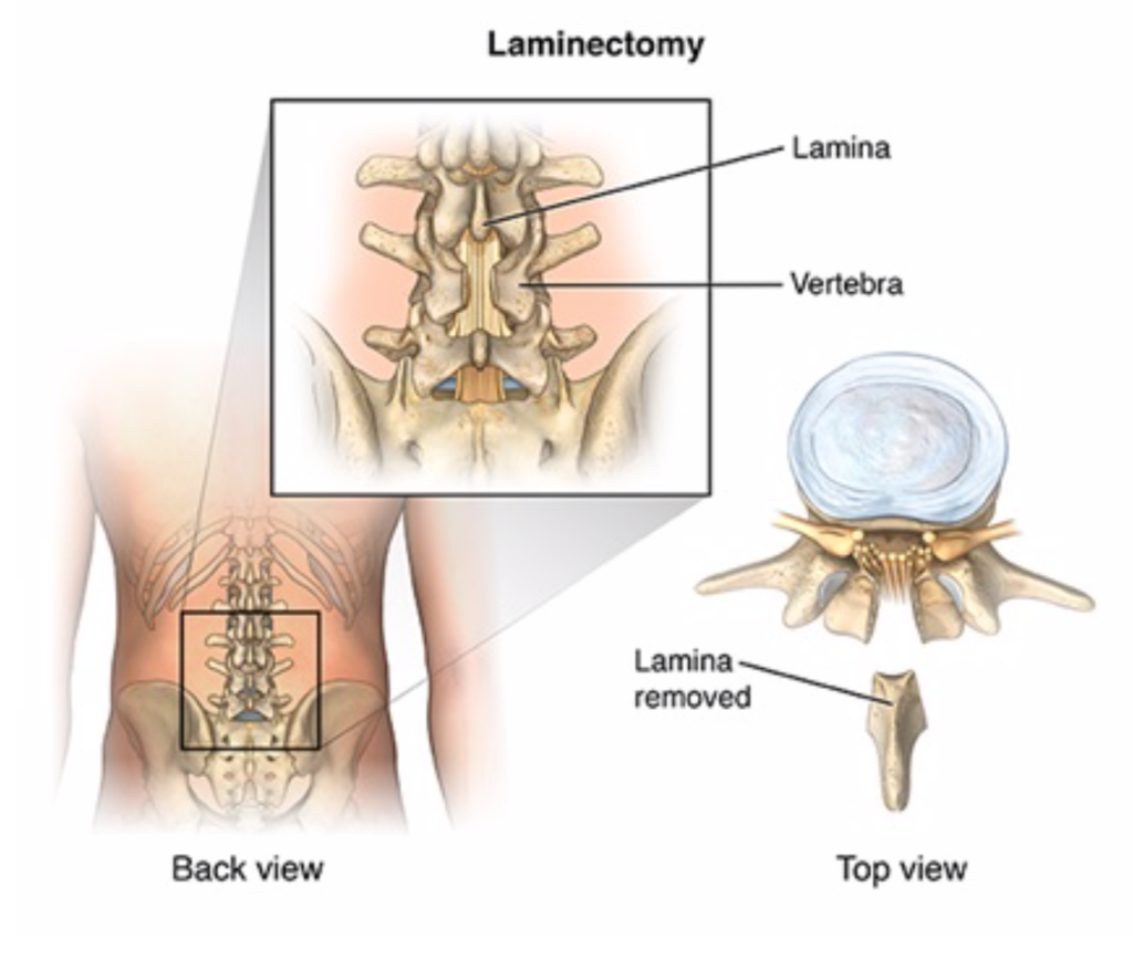  London+Neurosurgery+Partnership+laminectomy