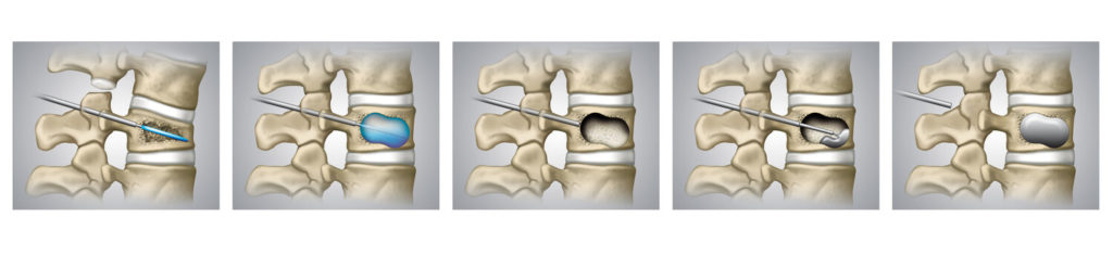 London Neurosurgery Partnership vertebroplasty