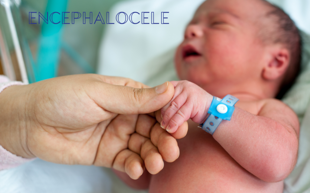 Encephalocele