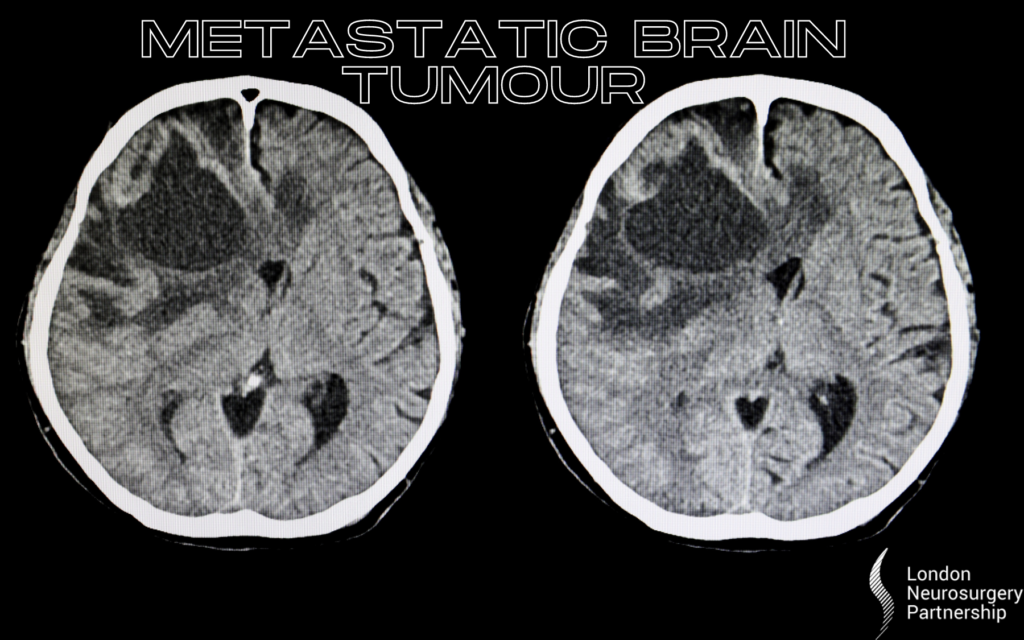 metastatic brain tumour