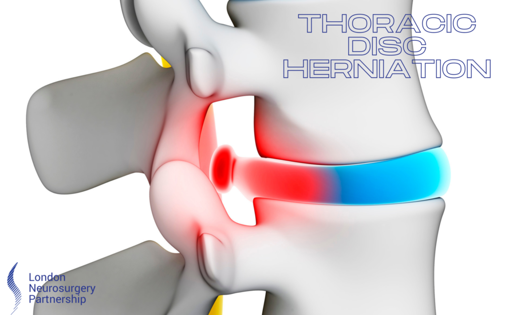 thoracic disc herniation