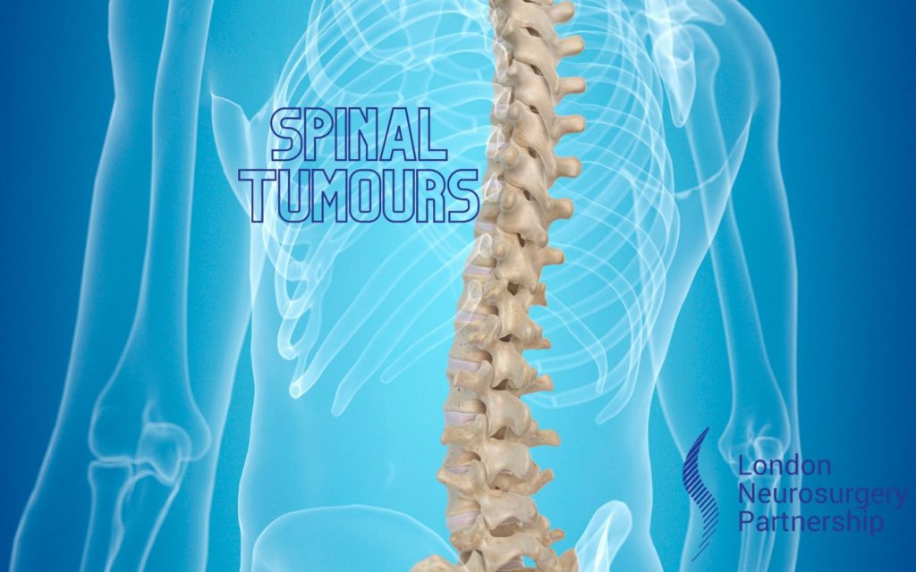 LNP spinal tumours