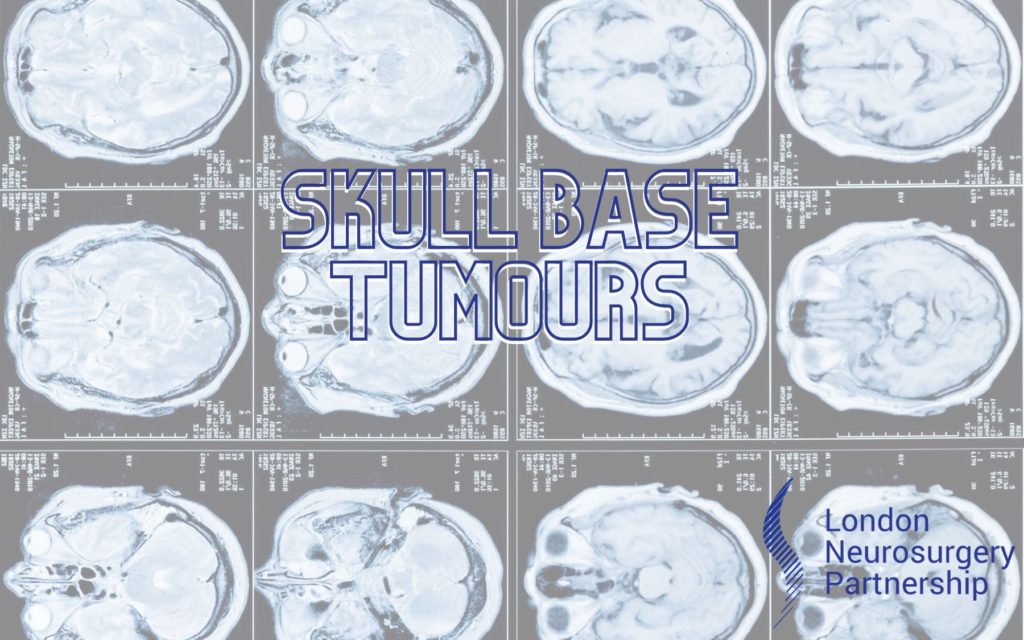 skull base tumours