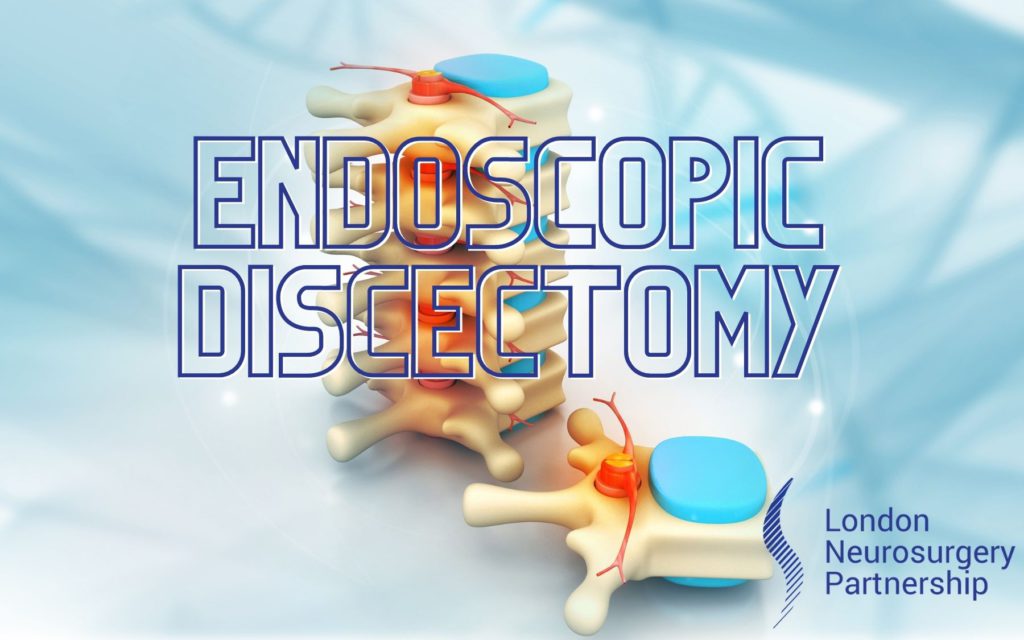 Endoscopic discectomy LNP