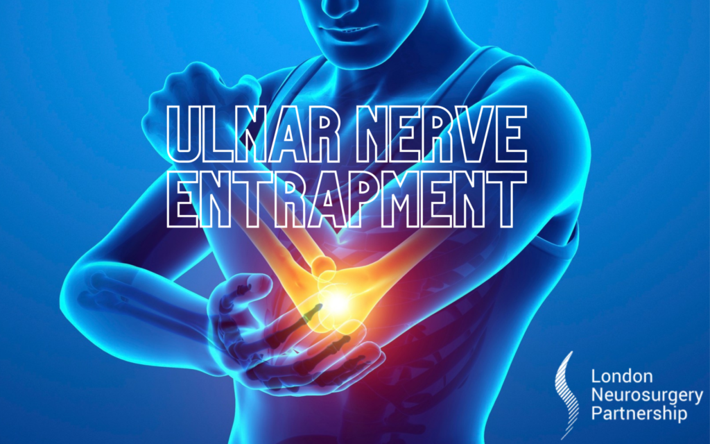 ulnar nerve entrapment