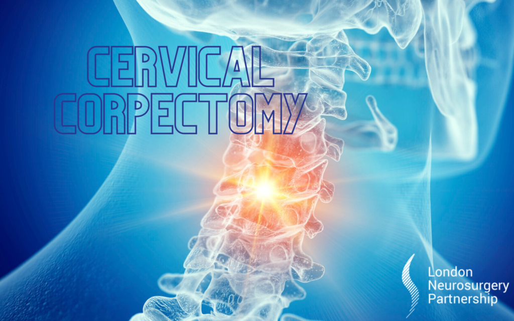 cervical corpectomy