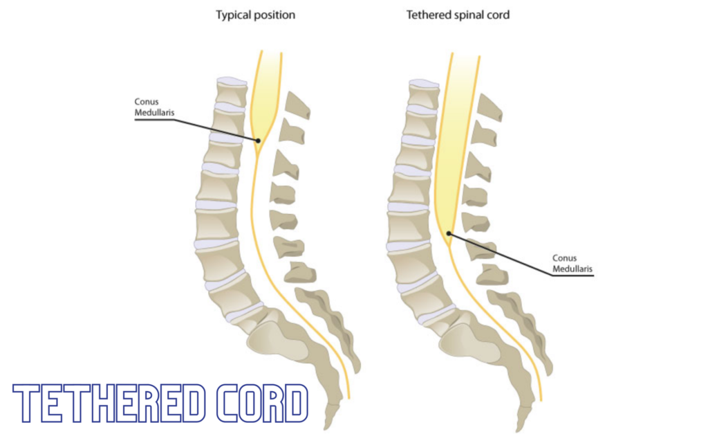 Tethered Cord – condition and symptoms