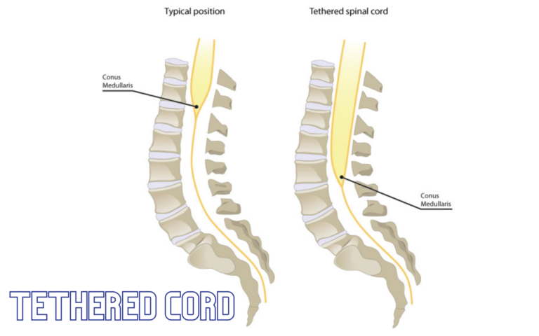 tethered-cord-condition-and-symptoms-how-to-treat